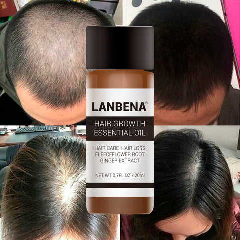 LANBENA Andrea Croissance des Cheveux Perte De Cheveux Essence Liquide 20...